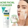 jabon antiacne 1 Jabón para el acné